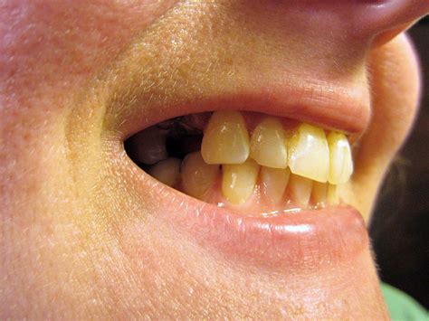 Dental Bridges Fill in the Gaps of Your Dental Care