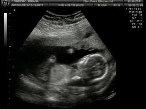 2D/3D Gender Ultrasound 17 weeks - YouTube