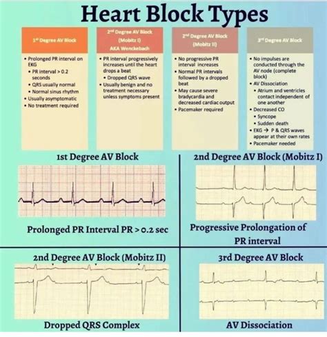 Heart Block Types - MEDizzy