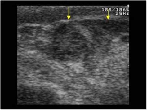 Urinary Tract and male reproductive system | 2.3 Scrotum : Case 2.3.1 Appendages and ...