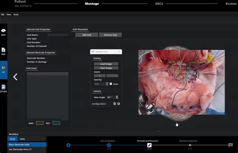 Dr. Christoph Guger on LinkedIn: Intraoperative ECoG grid placement with cortiQ 2.0 to map high ...