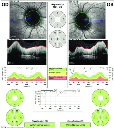 OCT of acute papilledema: increased RNFL thickness (right eye more than... | Download Scientific ...