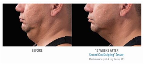 Coolsculpting Mini Chin Fat Reduction Virginia | Fairfax | DC