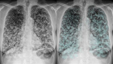 Chest X-ray - Lung cancer - Metastases (to lung)