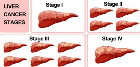 Liver Cancer Staging | St. Stamford Modern Cancer Hospital Guangzhou