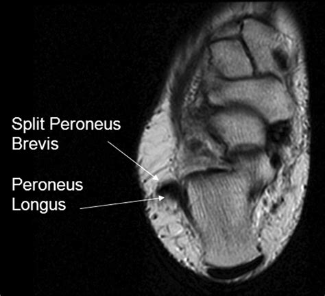 Split Peroneus Brevis Tendon: An Unusual Cause of Ankle Pain and Instability | American Board of ...