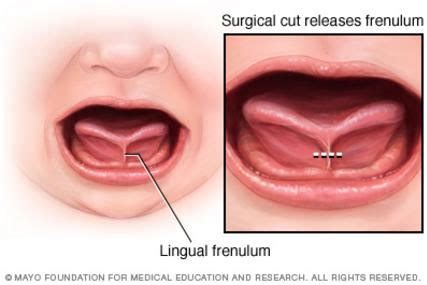 Laser Frenectomy Lower Lip Recovery | Sitelip.org