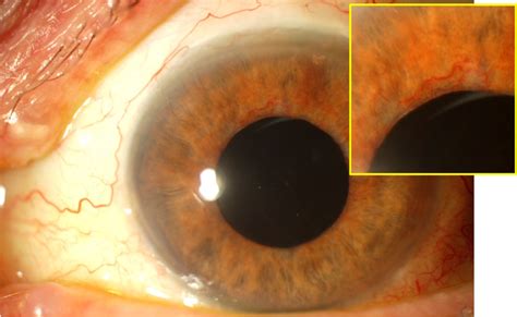 Glaucoma Information Secondary glaucoma - Can diabetes cause glaucoma ...