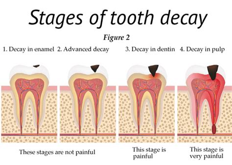 What is a Cavity?: Maritza O Jenkins, DMD: General Dentist