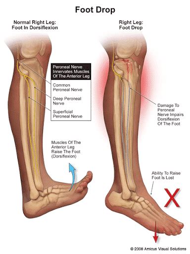 Current Diagnosis and Treatment of Superficial Fibular Nerve Injuries ...