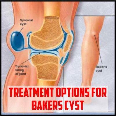 Treatment Options for Bakers Cyst - Sports Medicine Review