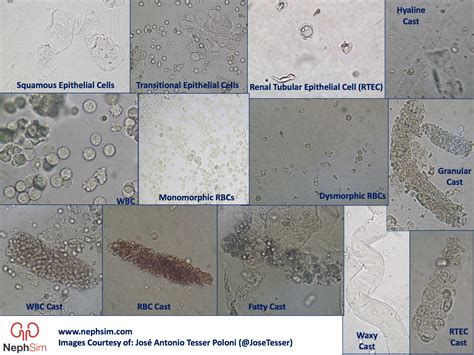 Hyaline Casts In Urine / Microscopic Analysis of Urine | Faculty of ...