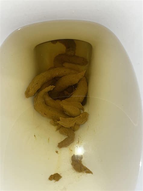 Colon Cancer Poop Look Like