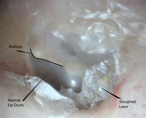 Ear Wax Images | McGovern Medical School