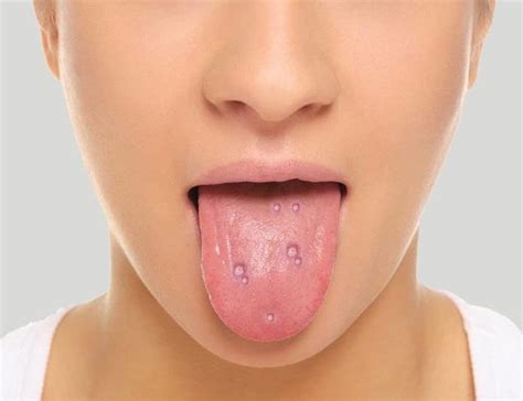 Blisters on tongue home remedies/Home remedies for canker sores