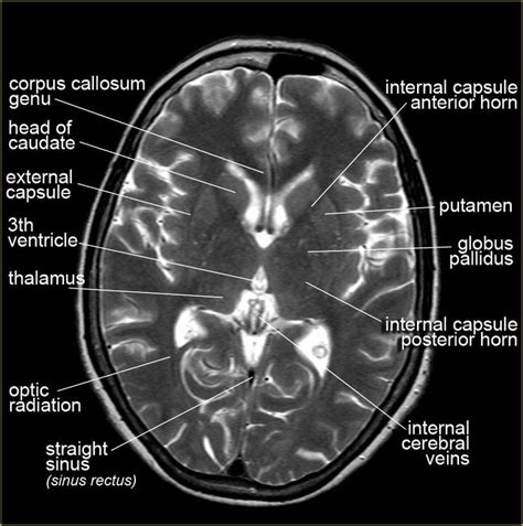 The Radiology Assistant : Brain Anatomy | Brain anatomy, Diagnostic ...