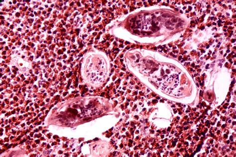 File:Schistosomiasis haematobia.jpg - Wikipedia