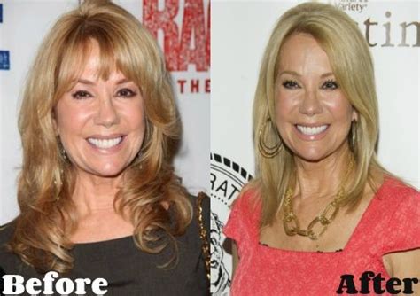 Kathie Lee Gifford before and after plastic surgery 03 – Celebrity ...