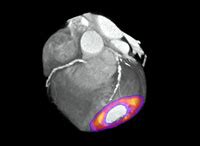 Cardiac PET scan (positon emission tomography) information | myVMC