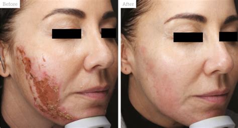 Special Feature: Managing Chemical Peel Complications - Aesthetics