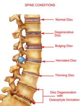 Types Of Back Surgery - Discectomy, Spinal Fusion, Laminectomy