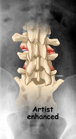 Lumbar Facet Joint Arthritis | eOrthopod.com