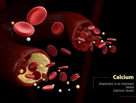 EVERYTHING YOU NEED TO KNOW ABOUT CALCIPHYLAXIS