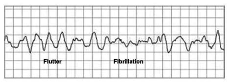 A.10) Coarse ventricular fibrillation mixed with ventricular flutter ...