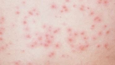 Hot Tub Rash - Treatment, Pictures, Symptoms, Causes