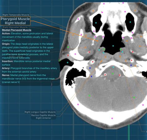 Medial Pterygoid Muscle - Review and CT images : r/XAnatomy