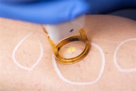 Vascular Laser Treatments - Dermetics