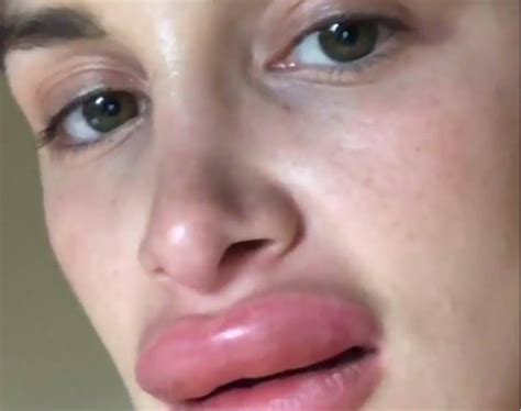 PSA: Here’s What Happens When You Have An Allergic Reaction To Lip Fillers - Pedestrian TV