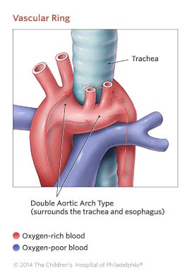 Vascular Ring due to double Ao arch - most common Ao arch anomaly to cause symptoms | Vascular ...