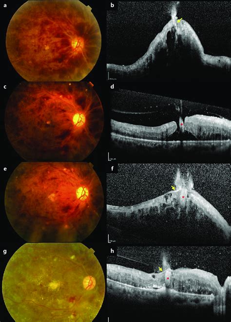 Fundus photographs (FPs) and horizontal macular optical coherence ...