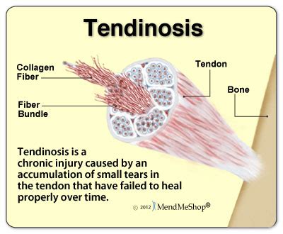 Tendinopathy of the Achilles