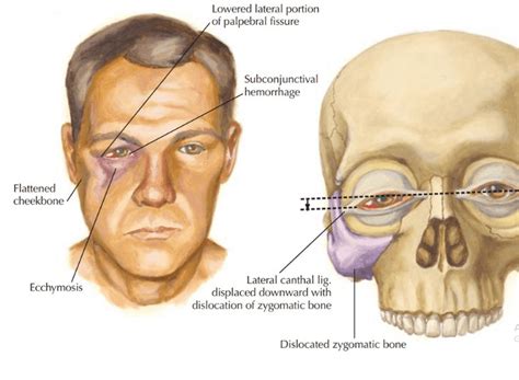 Facial Fractures - Maxillofacial