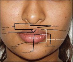 7 Upper Lip Lift Surgery ideas | upper lip, lips, surgery