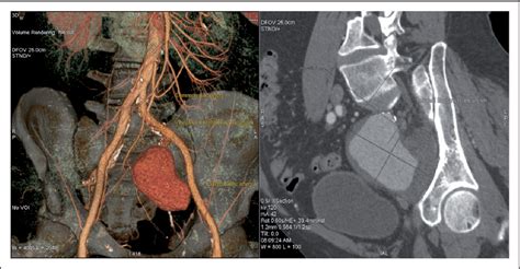 Figure 2 from A rare case of large isolated internal iliac artery aneurysm with ureteral ...