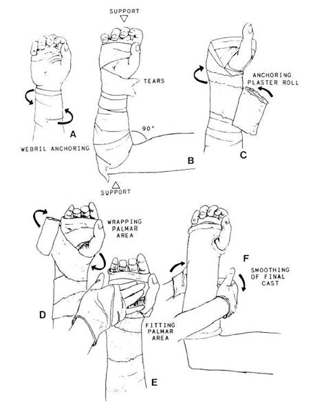 Figure 5-4.Applying A Short Arm Cast.