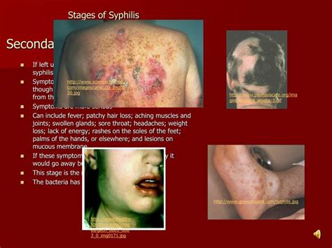 Stages Of Syphilis Chart