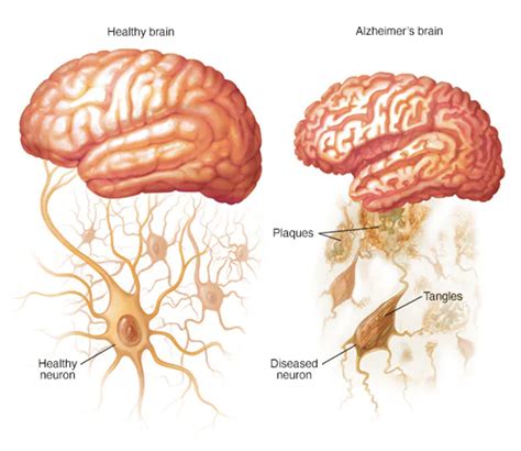 Silo Pharma Advances Alzheimer’s Disease Treatment with SPC-14 - The Dales Report