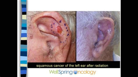 Skin Cancer and Radiation - YouTube