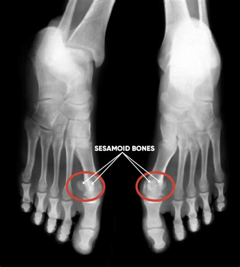 Sesamoid Fracture - Golden State Orthopedics & Spine