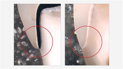 Choosing Between Zirconia Crowns and PFM Crowns | Glidewell