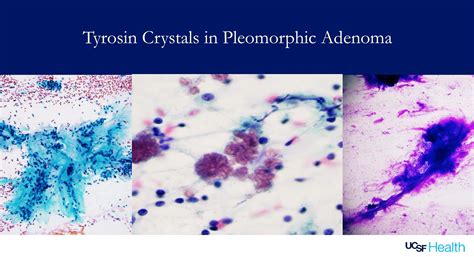 Tyrosine Crystals Pleomorphic Adenoma