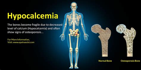 Calcium Deficiency Disease Hypocalcemia Causes Symptoms Diagnosis | Hot ...