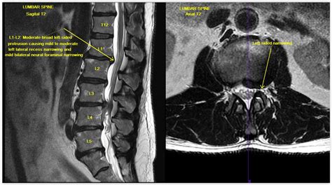 Hypertrophied Ligamentum Flavum Mri : The Radiology Assistant : Lumbar ...