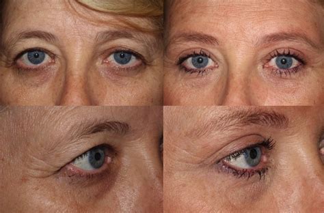 Brow lift, upper and lower blepharoplasty, and ptosis repair (left eye) - Dr. Guy Massry