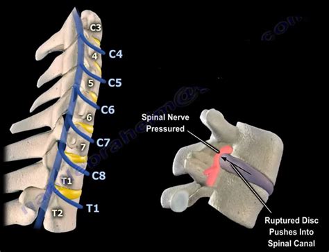 Neck Pain, Cervical Disc Herniation, & Cervical Radiculopathy | by ...