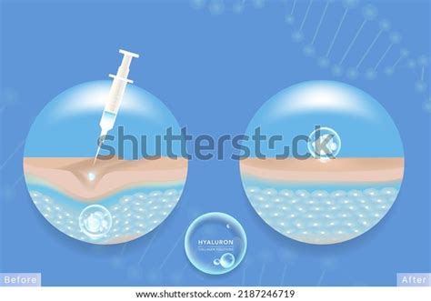 Hyaluronic Acid Before After Skin Solutions Stock Vector (Royalty Free) 2187246719 | Shutterstock